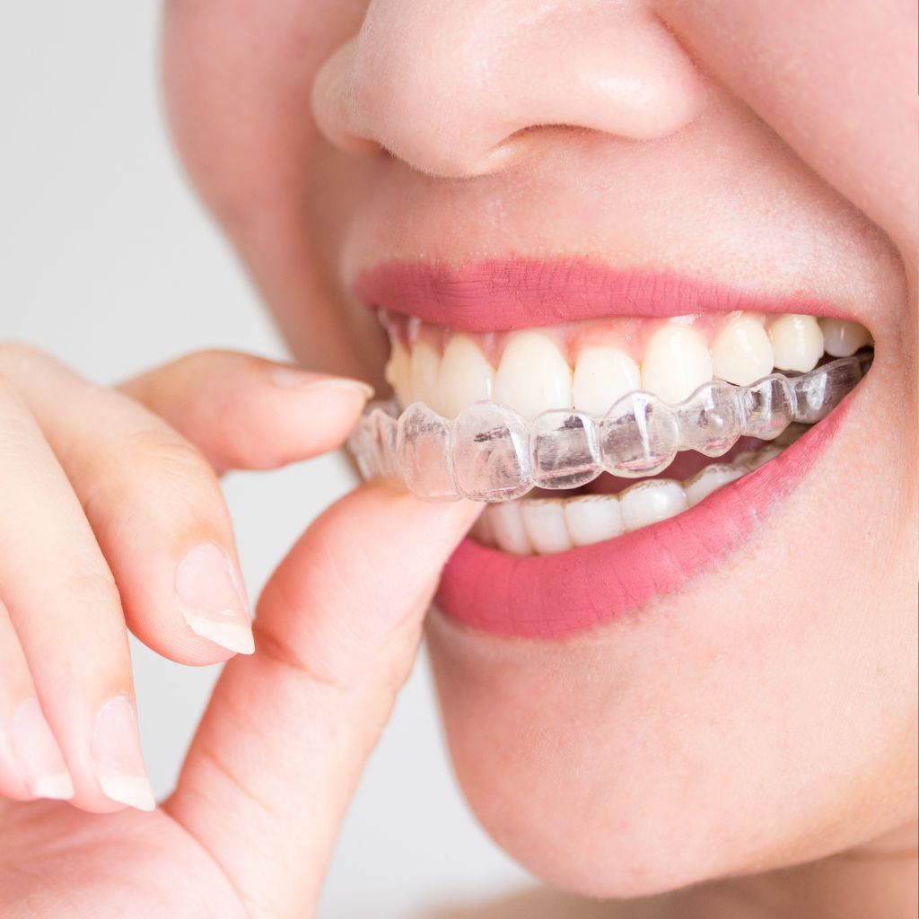invisalign - Coastal Cosmetic and Family Dentistry , FL