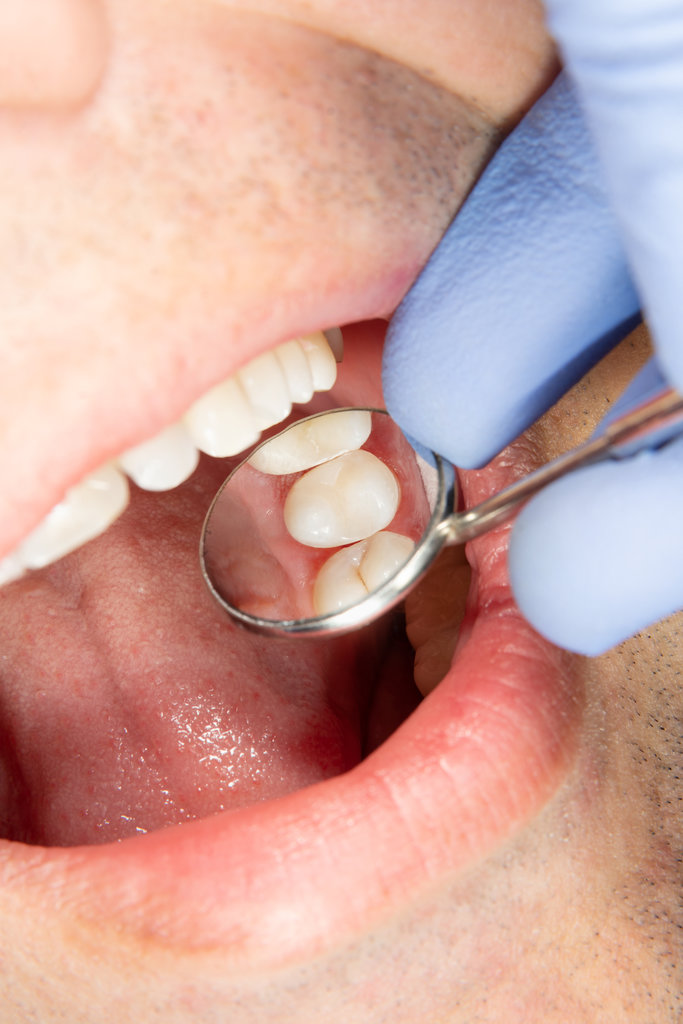 two chewing side teeth of the upper jaw after treatment of caries. Restoration of the chewing surface with a photopolymer filling material using the Rubber Dam system