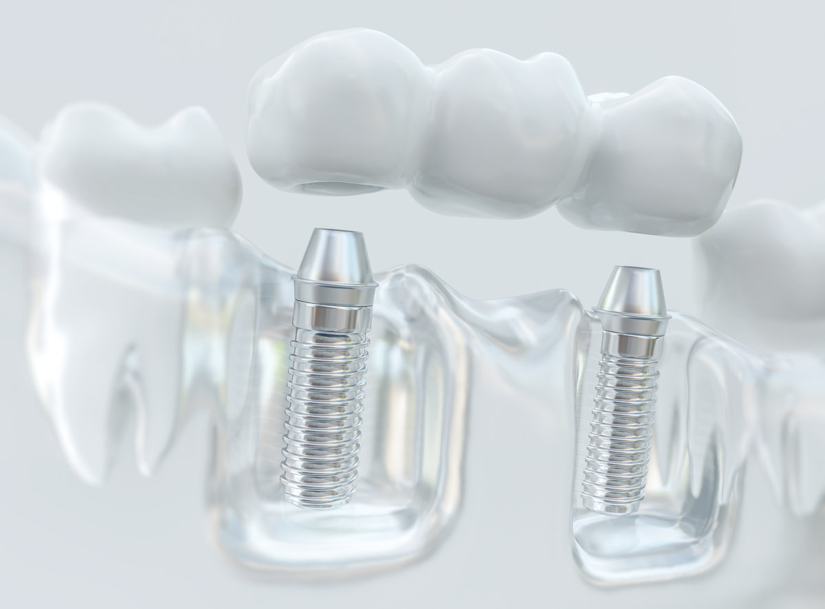 Implants with dental bridge -- 3d rendering