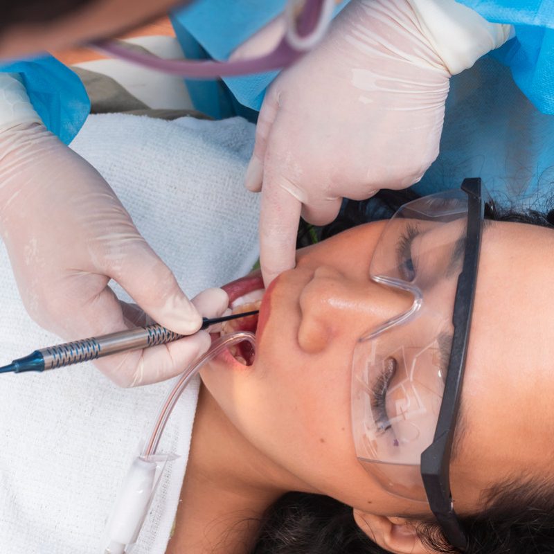 Wide view of dentist applying composite filling to a lower premolar of a female patient wearing protective glasses during treatment.